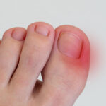 uñas encarnadas
